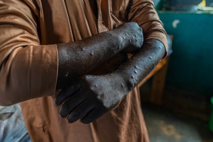 Public HEALTH: 2 cases (Mpox) under close surveillance and 2 other cases in isolation